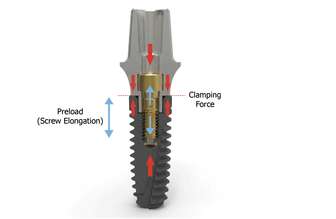 Screw Preload Explained: The Hidden Key to Implant Stability